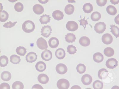 hồng cầu hình bia, target cells