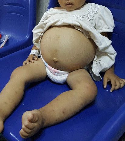 tan máu bẩm sinh, thalassemia, biến chứng bệnh tan máu bẩm sinh