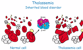 Bệnh Thalassemia có những dạng chính nào?
