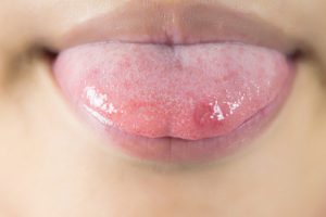Ung thư lưỡi, Nguyên nhân, các giai đoạn và cách phòng ngừa